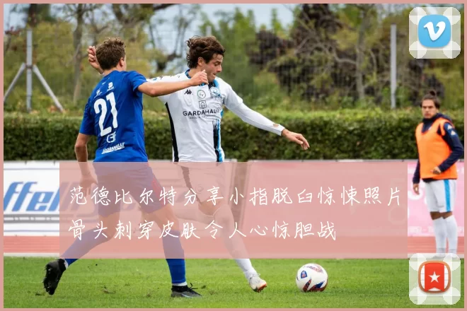 范德比尔特分享小指脱臼惊悚照片骨头刺穿皮肤令人心惊胆战